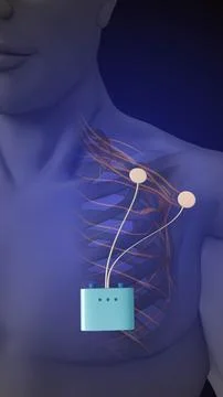 Therapy using peripheral nerve stimulation in the shoulder region Stock Illustration