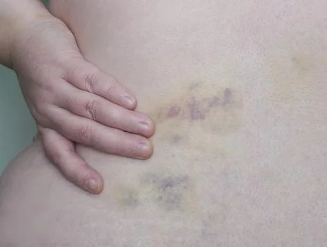 There is a massive bruise on the side of the torso Foto stock