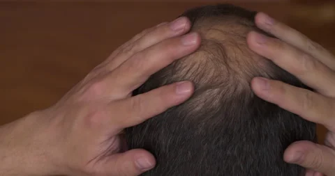 Thinning crown, male pattern baldness 스톡 동영상 157365817
