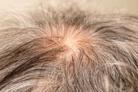 Thinning Hair Stock Photos