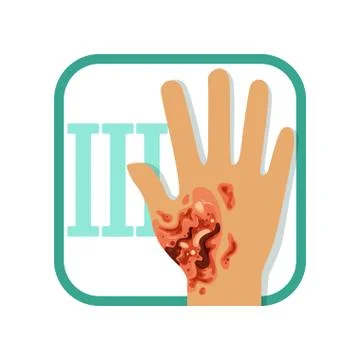 Third degree of burn. Hand with damaged outer (epidermis) and inner (dermis Stock Illustration