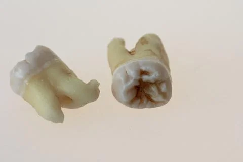 Third molars Stock Photos