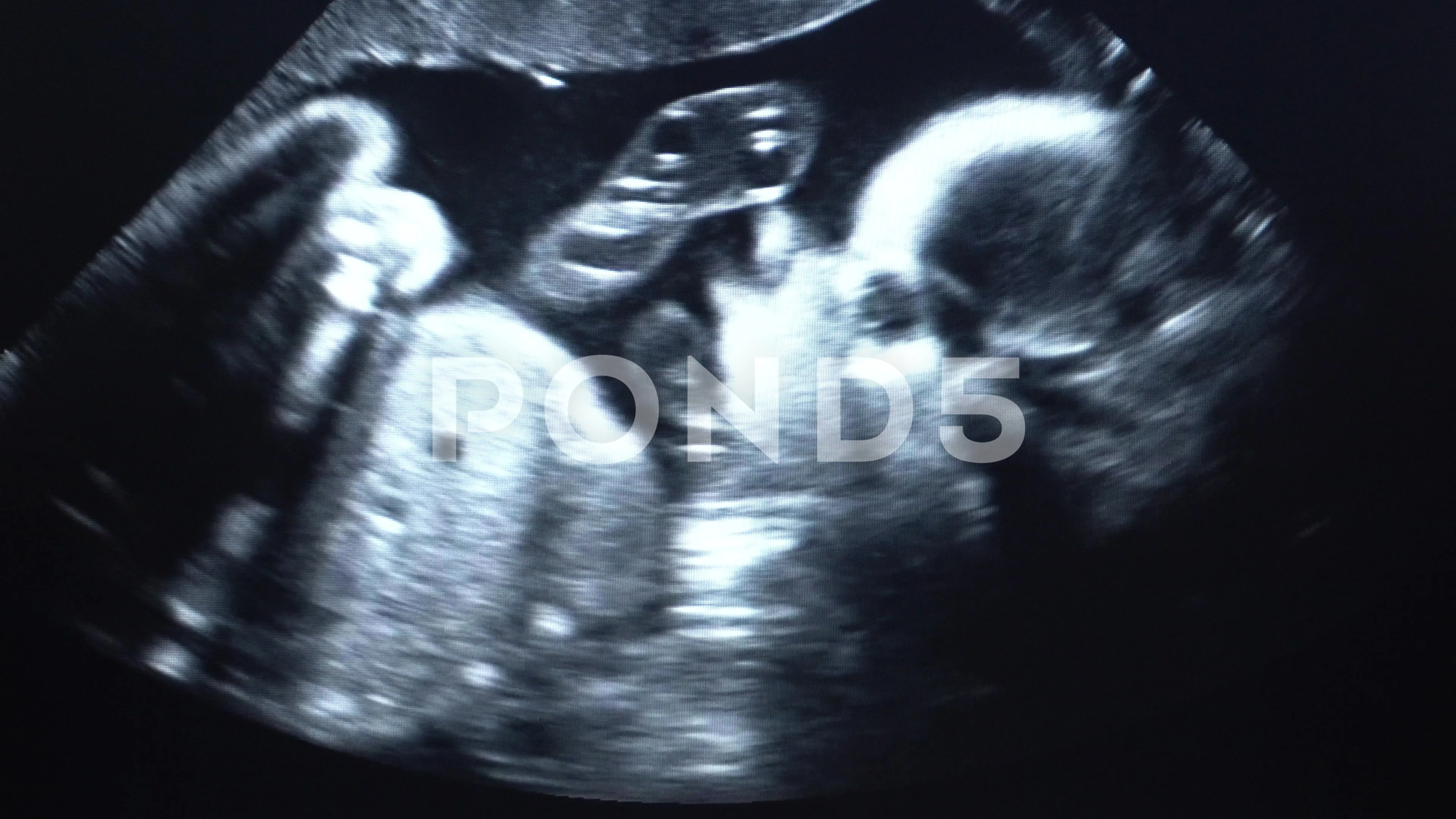 Normal pregnancy: Third trimester Video & Image