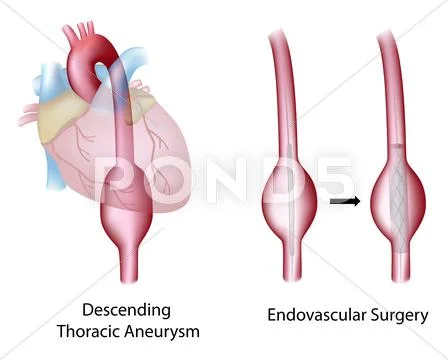 Thoracic aortic aneurysm Stock Illustration