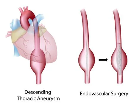 Thoracic aortic aneurysm Stock Illustration