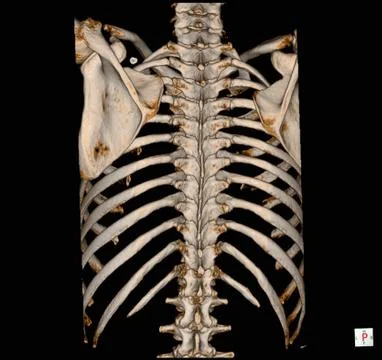 Thoracic spine ct with 3D reconstruction . The film shown thoracolumbar injur Stock Photos