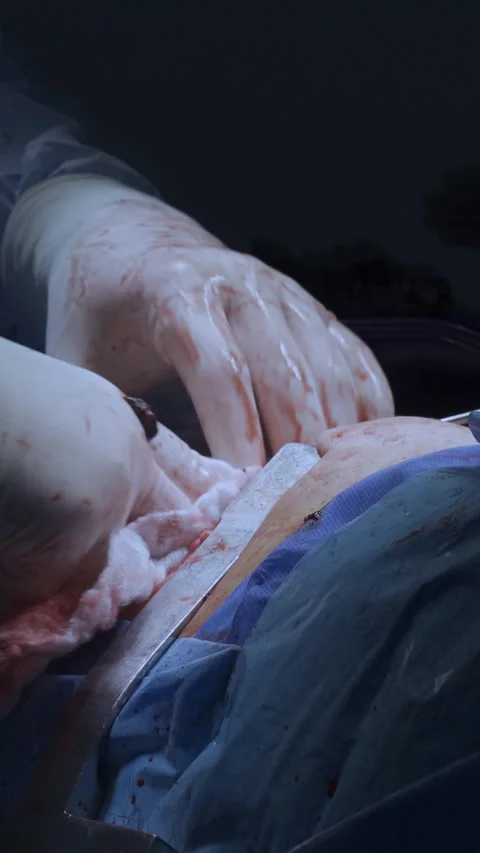 Thoracic surgeons performing a left lower lobe lung surgery. Stock Footage 242738129