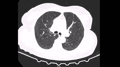Thorax Computed Tomography 库存影片 196876716