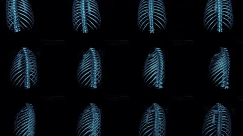 Thorax MRI Scan Stock Footage 87162655