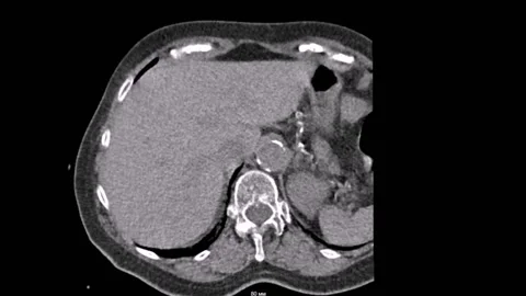 Thorax pathology Computed Tomography 库存影片 196876720