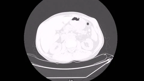 Thorax tuberculosis Computed Tomography 库存影片 196876717