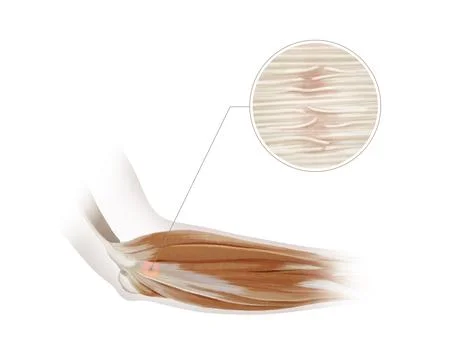 This is a thorough anatomical representation of arm muscles with a detailed Stock Illustration