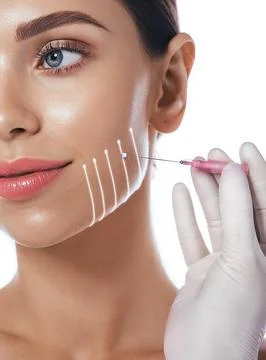 Thread facelift with arrows, concept of lifting skin, close up. Procedure fac Stockfoto's