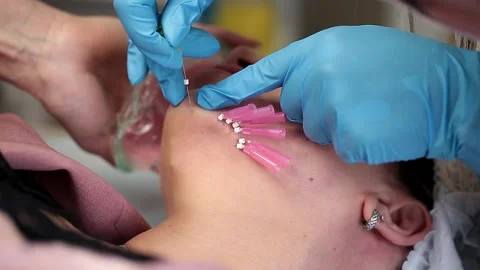 Thread lifting is a cosmetological procedure for face rejuvenation. Stock Footage 201418595