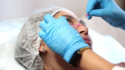 Thread lifting is a cosmetological procedure for face rejuvenation. Stock Footage 201418906