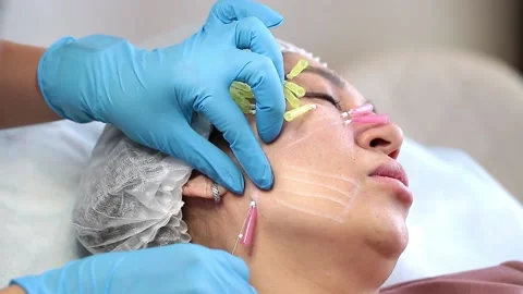 Thread lifting is a cosmetological procedure for face rejuvenation. Stock Footage 201418945