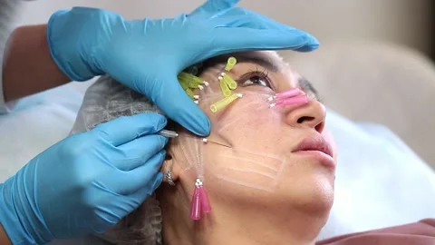 Thread lifting is a cosmetological procedure for face rejuvenation. Stock Footage 201418952
