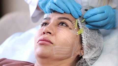 Thread lifting is a cosmetological procedure for face rejuvenation. Stock Footage 201419265