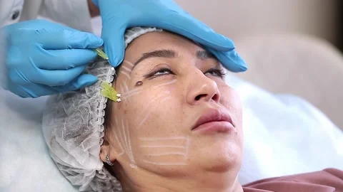 Thread lifting is a cosmetological procedure for face rejuvenation. Stock Footage 201419270