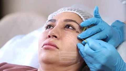 Thread lifting is a cosmetological procedure for face rejuvenation. Stock Footage 201419287