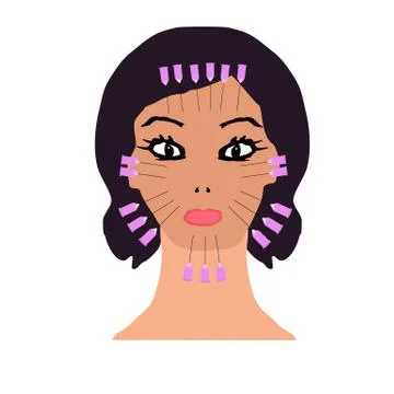 Thread lifting on the face. Threads for a facelift. Mesotherapy Wrinkles Stock Illustration