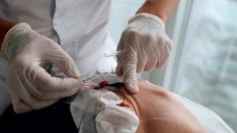 Threadlifting with mesothreads at aesthetic clinic, installing thread-kogi under Stock Footage 198989478