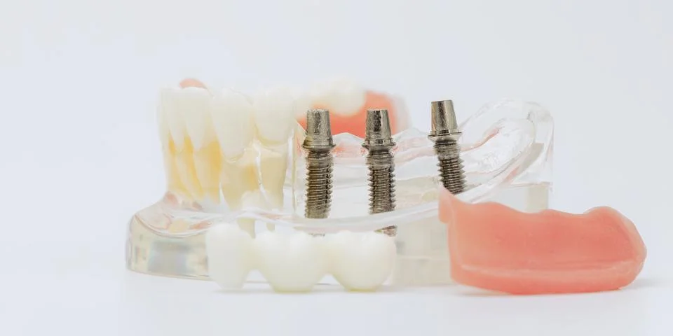 Three Dental Implants with Detached Bridge and Gum Components Stockfoto's