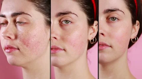 Three halves of female face showing the result after rosacea treatment. Stock Footage 147075159