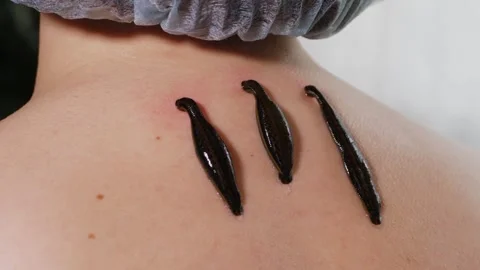 Three leeches on patients neck close up hirudotheraphy concept 스톡 동영상 279985152