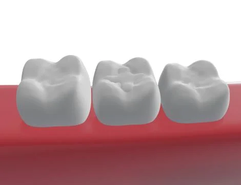 Three molar teeth in the gum, polymer filling Stock Illustration