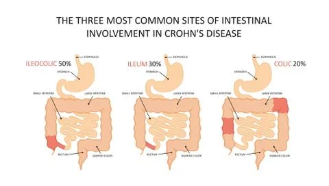Three most common sites of intestinal involvement in crohn's disease Stock Illustration