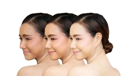 Three pictures compared before and after treatment for freckles Stock Photos