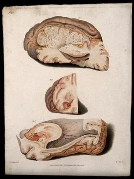 Three sections of diseased brain. Coloured stipple etching by W. T. Fry aft.. Stock Illustration