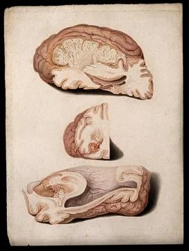 Three sections of diseased brain. Coloured stipple etching by W. T. Fry aft.. Stock Illustration