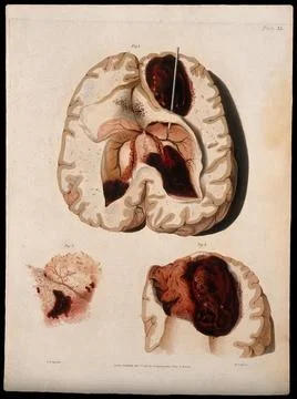Three sections of diseased brain. Coloured stipple etching by W. T. Fry aft.. Stock Illustration