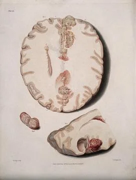 Three sections of diseased brain. Coloured stipple etching by W. T. Fry aft.. Illustrazione stock