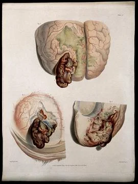 Three sections of diseased brain: hernia cerebri. Coloured stipple etching .. Illustrazione stock