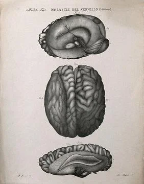 Three sections of diseased brain, numbered for key. Lithograph by Batelli a.. Illustrazione stock