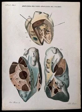 Three sections of diseased heart and lungs showing blood clots and haemorrh.. Illustrazione stock