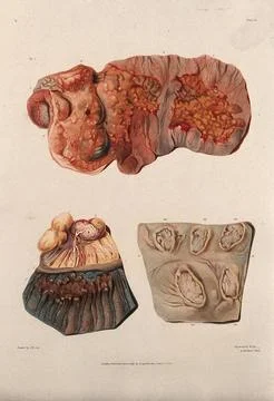 Three sections of diseased intestines. Coloured mezzotint by W. Say after F.. Illustrazione stock