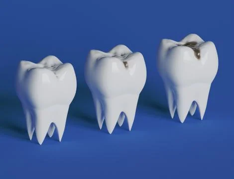 Three stages of tooth decay, caries Stock Illustration