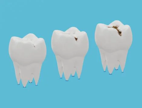 Three stages of tooth decay, caries Illustrazione stock