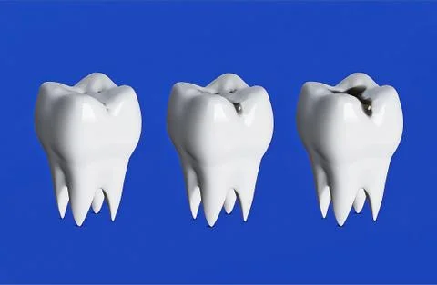 Three teeth in a row, Three stages of tooth decay, caries, sore teeth Stock Illustration