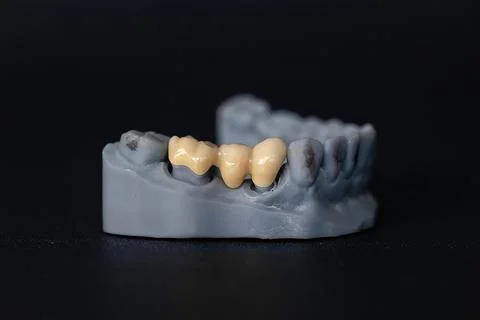 Three-unit ceramic dental bridge on 3D printed model for tooth restoration Stock Photos
