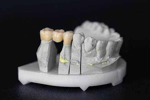 Three-unit dental bridge on plaster dental model for prosthetic restoration Stock Photos