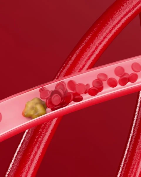 Thrombosis forms in blood vessels Видео 329611439