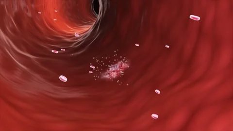 Thrombus formation inside a blood vessel obstructing blood flow Stockbeeldmateriaal 345199428