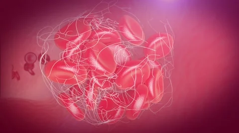 Thrombus thrombs blood clot formation inside the blood vessel Stock Footage