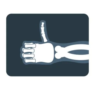 Thumbs up x-ray. Bones of hand shows all good. Medical illustration Stock Illustration