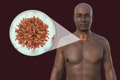 Thyroid cancer, 3D illustration Stock Illustration